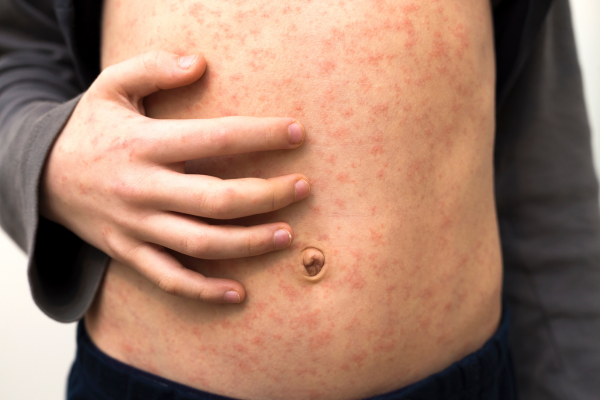 child with measles rash on their torso