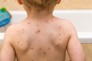 chickenpox in adults